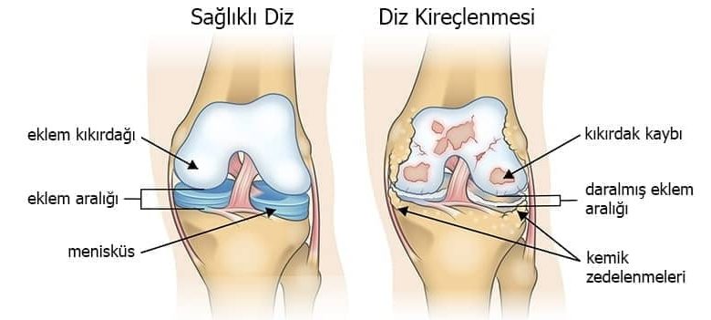 Dizleriniz ağrıyorsa hafife almayın! Kireçlenme belirtisi olabilir